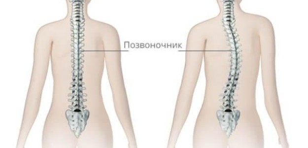 Детский сколиоз — советы и уроки массажа